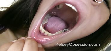 Teeth fillings
